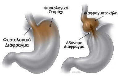 τι ειναι το αντρο στομαχου